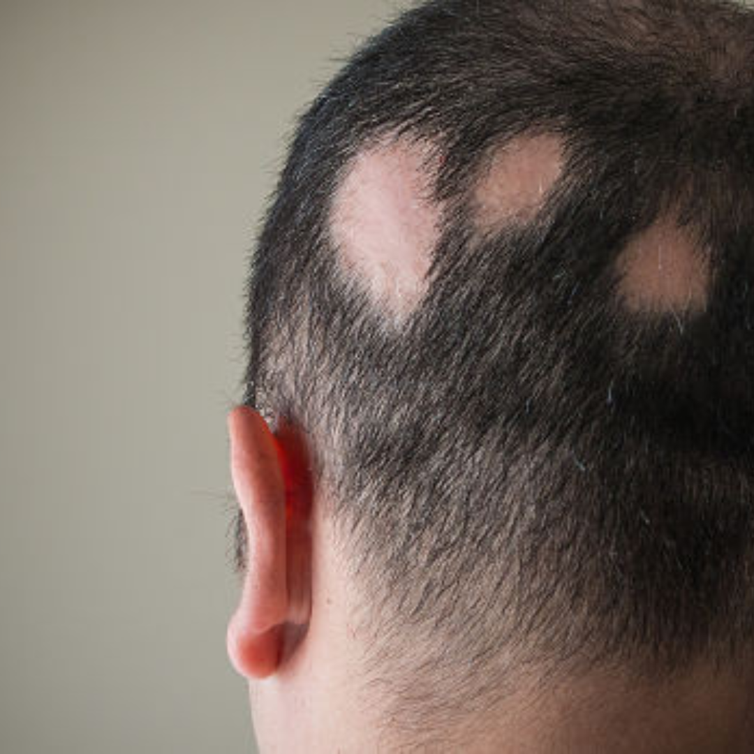 Alopecia Areata – Clive Hair